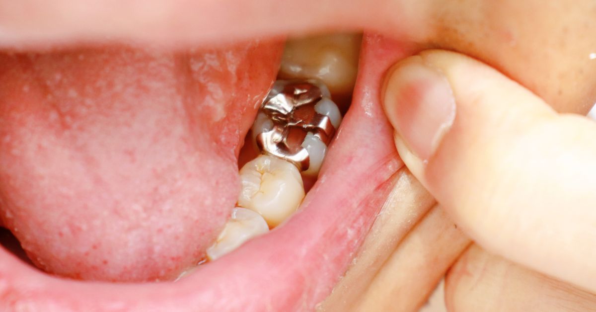 Why Do Kids Get Silver Teeth? Everything You Need to Know